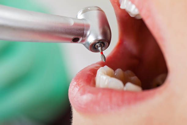 Best Broken or Chipped Tooth Repair in Shelburn, IN